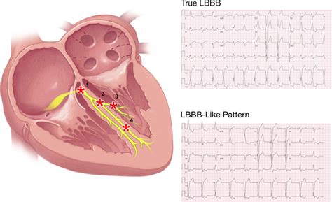 left bundle branch block symptoms